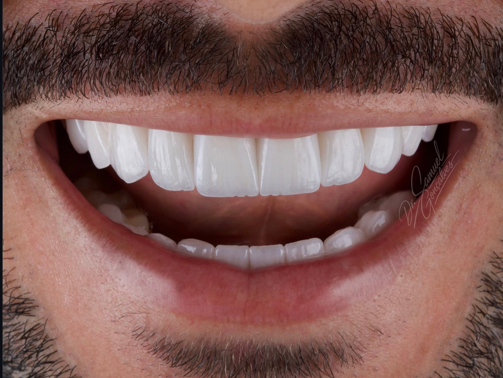 Sorriso frontal em detalhe — caso 01 do Dr. Samuel