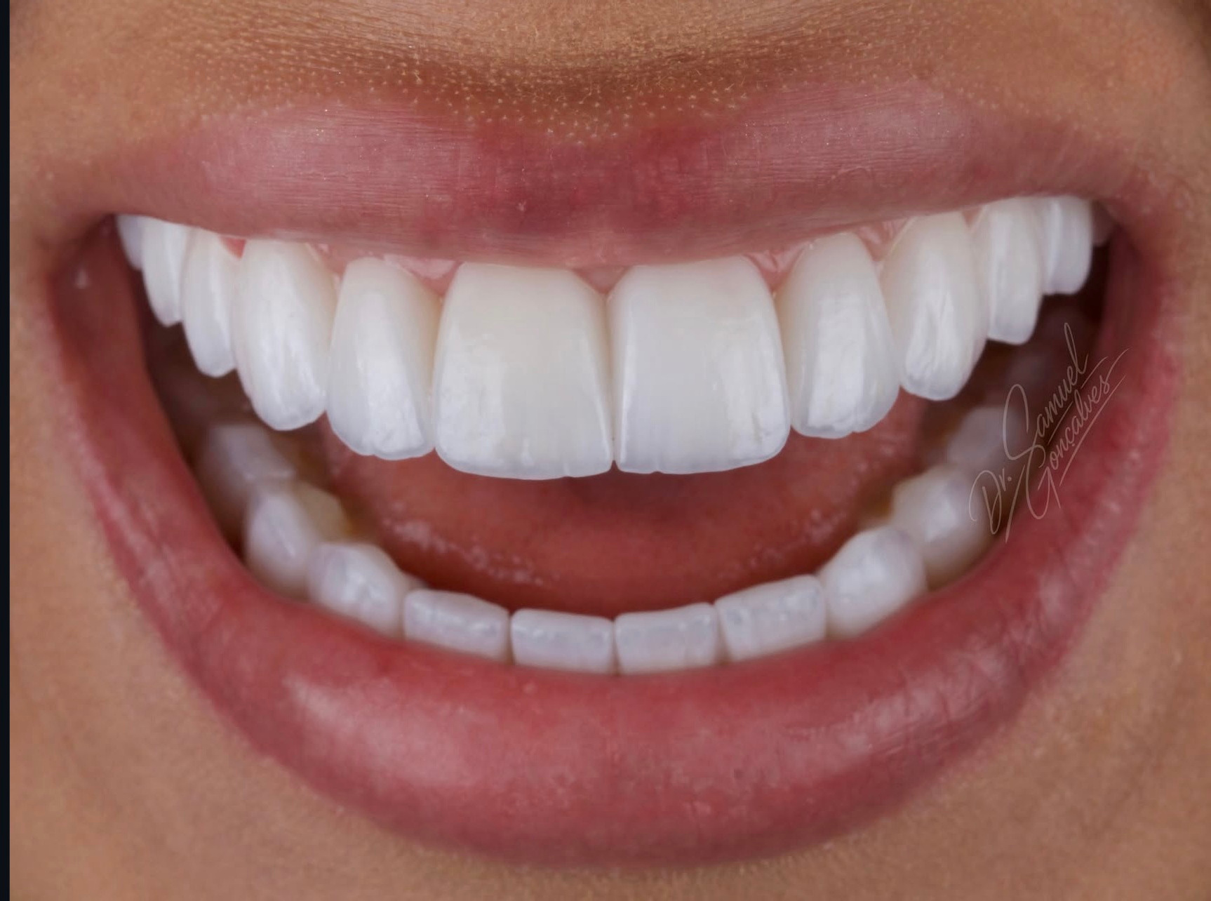 Sorriso frontal em detalhe — caso 02 do Dr. Samuel