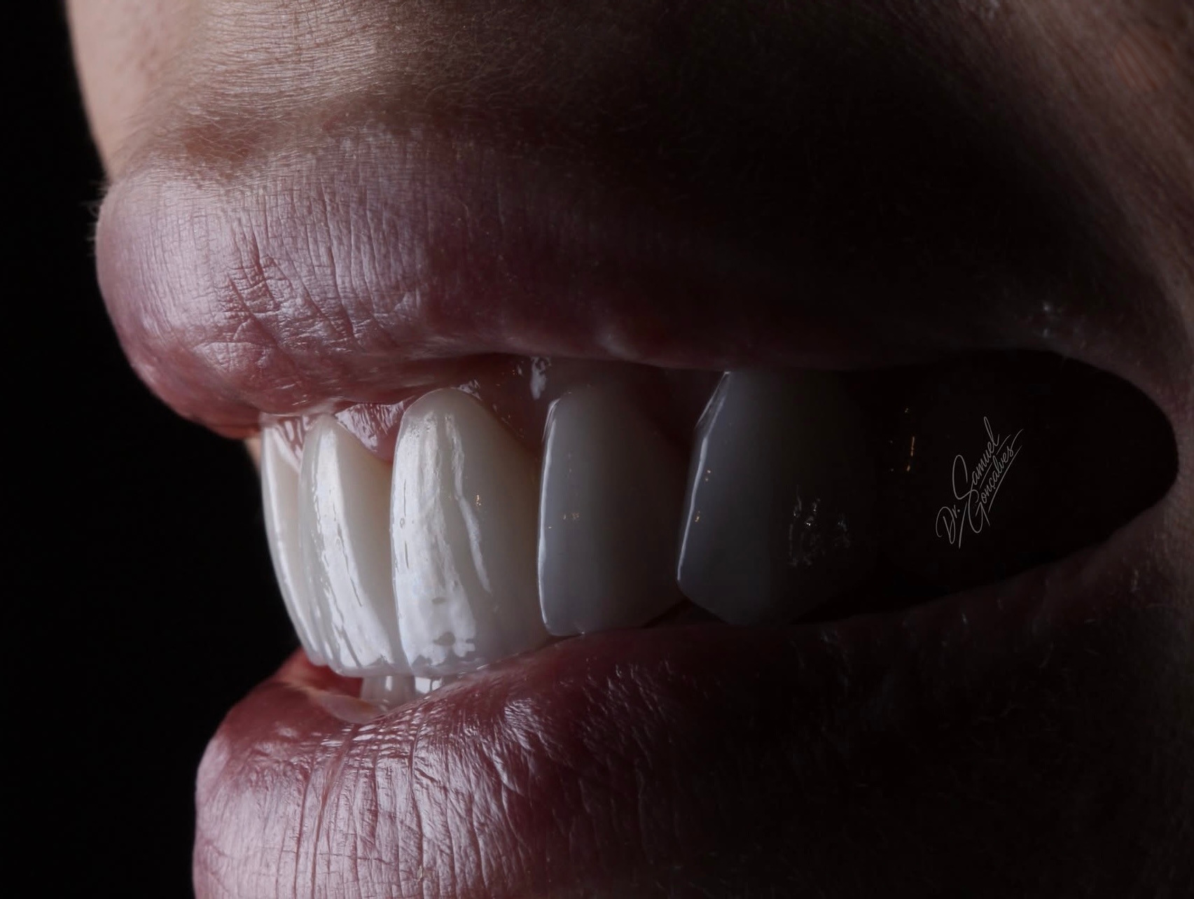 Sorriso lateral em detalhe — caso 03 do Dr. Samuel