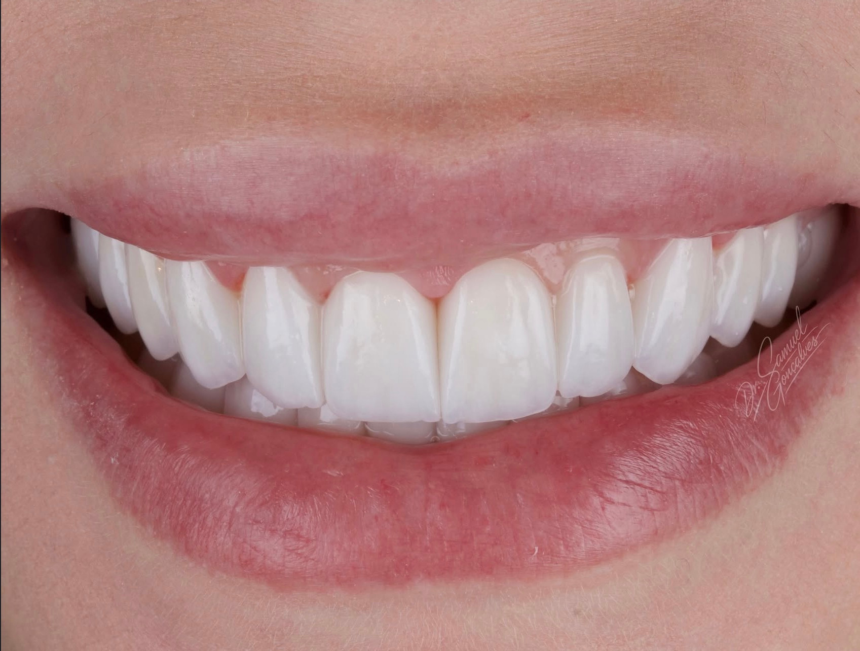 Sorriso frontal em detalhe — caso 04 do Dr. Samuel
