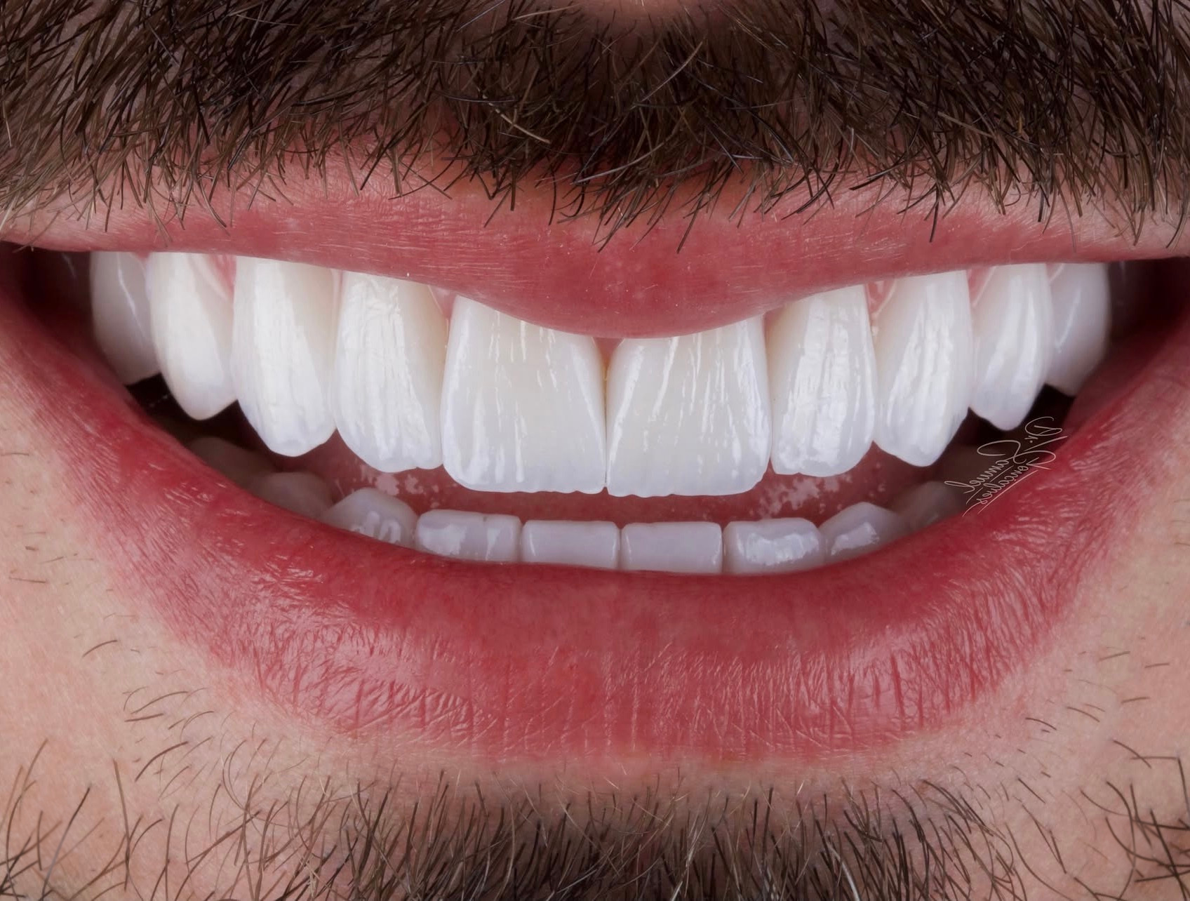 Sorriso frontal em detalhe — caso 05 do Dr. Samuel